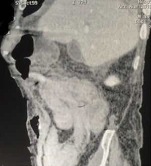 Corte anteroposterior: típica imagen en seudoriñón.