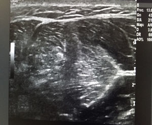 Imagen ecográfica que muestra una solución de continuidad a nivel de la fascia del músculo tibial anterior de 7,4mm con protrusión de ecogenicidad similar al músculo subyacente.