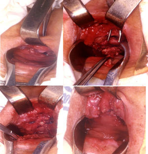 Fístula rectovaginal obstétrica. Reparación con colgajo rectal grueso.