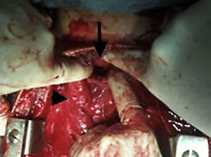 Identificación de segmentos traqueales: la flecha indica la tráquea proximal; la punta de la flecha indica los vasos cervicales.