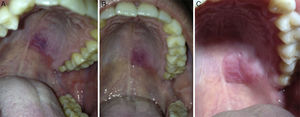 A) Evolución de la lesión a los 5 días, B) a los 12 días, y C) a los 20 días posteriores a cirugía esofágica.