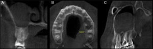 Imágenes del CBCT donde se observa indemnidad de corticales óseas y conservación de la línea periodontal del diente 15 (2,7) en el plano coronal (A), axial (B) y sagital (C).