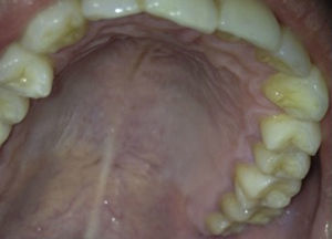 Control 30 posterior a la biopsia. Mucosa palatina indemne con remisión total de la lesión.