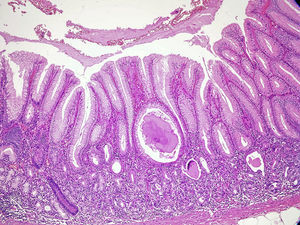 Mucosa gástrica corporal, con foco de metaplasia intestinal y calcificación foveolar quística. Tinción de hematoxilina-eosina ×10.