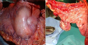 Pieza operatoria: vista extrínseca del estómago extirpado donde se aprecia una depresión a nivel de tumoración (A); vista intrínseca de la tumoración intraluminal gástrica (B).
