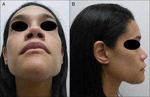A, B) Examen extraoral que evidencia aumento del volumen de las regiones mandibulares anterior y submental.