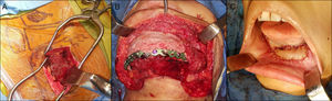 A) Injerto óseo de cresta iliaca posterior. B) Reconstrucción mandibular con injerto cortico-esponjoso e Infuse®. C) Reconstrucción intraoral con colgajo submental.