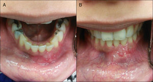 A, B) Examen intraoral que muestra tumoración mandibular anterior con expansión de cortical bucal y lingual.