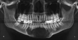 Reconstrucción tipo ortopantomografía que revela gran lesión mandibular multilocular.