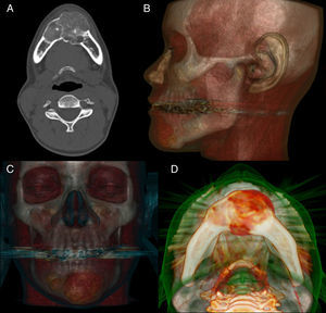 Tomografía computada maxilofacial. A) Vista axial que muestra densidad mixta de la lesión. B) Reconstrucción 3D de la vista lateral. C) Reconstrucción 3D de la vista anterior. D) Reconstrucción 3D de la vista mandibular inferior.