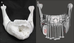 A) Modelo #1 donde se han planificado los márgenes de resección (líneas punteadas) por mesial de 3,7 y 4,6. B) Diseño del modelo #2 con osteotomías virtuales y representación de posibles posiciones de los futuros implantes dentales.
