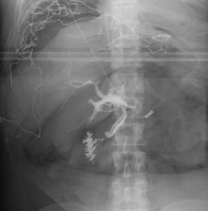 Imagen mediante colangiografía intraoperatoria: se evidencia fuga de contraste a nivel del colédoco distal, porción intrapancreática.
