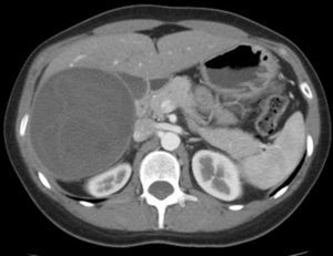 Corte de tomografía computada que muestra a nivel hepático una gran lesión heterogénea de 10,5 por 9,3 cm de diámetro que comprometía los segmentos V y VI, con finas membranas internas compatible con un quiste hidatídico hepático. Dicho quiste estaba en íntimo contacto con la vena cava inferior.