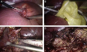 Etapas de la cirugía laparoscópica para el tratamiento de los quistes hidatídicos hepáticos. A) Colocación de gasas largas embebidas en solución fisiológica hipertónica alrededor del quiste, punción, aspiración y posterior inyección de agente escolicida. B) Tras destechar el quiste se reseca su contenido, membrana laminar y vesículas hijas. C) Disección y resección de la membrana periquística, separándola del parénquima hepático mediante bisturí ultrasónico. D) Exploración del lecho quirúrgico para detectar filtraciones biliares.
