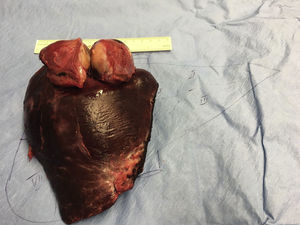 Pieza de hepatectomía derecha reglada con recidiva tumoral que afecta a la cúpula diafragmática derecha.
