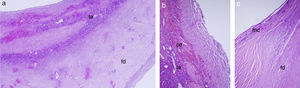 Aspecto histopatológico de la pared de un pseudoquiste esplénico. a. Microfotografía (hematoxilina-eosina [HE], ×4). Pared con fibrosis densa (fd), focos de hemorragia y tejido esplénico remanente (te). b. Microfotografía (HE, ×10). Pared con hemorragias, algunos fantasmas de cristales aciculares de colesterol (cc) y tejido esplénico remanente (te). c. Microfotografía (HE, ×10). Pared con fibrosis densa (fd) y focos con microcalcificaciones distróficas (mc). En ninguna de las 3 microfotografías se reconoce revestimiento epitelial.