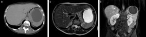 Se observa una lesión quística de contenido homogéneo en el polo superior del bazo, sin tabiques ni calcificaciones. a. TC de abdomen con contraste, corte transversal. b. RMN de abdomen, corte transversal. c. RMN de abdomen, corte coronal.