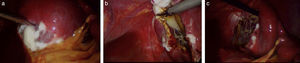 Imágenes obtenidas de laparoscopia. Se observa una lesión dependiente del polo superior del bazo; en la primera imagen (a) se aspira su contenido. La segunda y tercera imágenes corresponden al destechamiento del quiste (b y c).