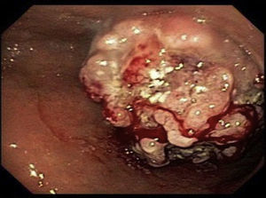 Endoscopia digestiva alta. Tumor polipoide friable, irregular, con zonas ulceradas, de 8cm, a nivel de la cara anterior del cuerpo del estómago.