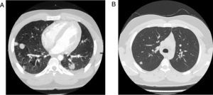 (A) Angio-TC de tórax que muestra nódulos metastásicos pulmonares bilaterales. (B) TC de tórax de control (un año después). Nódulo pulmonar en segmento apicoposterior, lóbulo superior derecho.