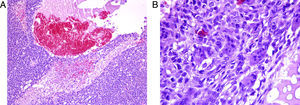 (A) Biopsia testicular, con tinción de hematoxilina-eosina, que muestra necrosis hemorrágica tumoral extensa. (B) Biopsia testicular, con tinción de hematoxilina-eosina, que muestra células gigantes multinucleadas características de coriocarcinoma.