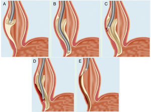 Esquema representativo de los pasos críticos de la técnica POEM. A) Elevación e incisión de la mucosa esofágica. B) Creación del túnel submucoso. C) Miotomía de las fibras circulares internas de la pared esofágica. D) Extensión de la miotomía hasta el estómago. E) Cierre del defecto en la mucosa.Fuente: modificado con el permiso del Dr. H. Inoue.