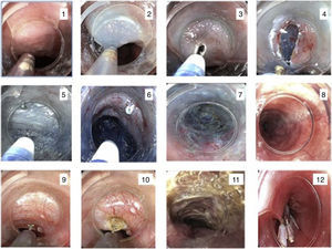 Secuencia de pasos en la técnica POEM. 1,2) Elevación de la mucosa. 3,4) Mucotomía longitudinal. 5-8) Creación del túnel submucoso. 9-11) Miotomía. 12) Cierre de mucotomía con clips.