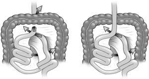 Se muestran (flechas) los distintos espacios por donde pueden ocurrir las hernias internas. A la izquierda, bypass retrocólico: A) defecto de Petersen; B) defecto mesentérico; C) defecto transmesocólico. A la derecha, bypass antecólico: A) defecto de Petersen; B) defecto mesentérico.