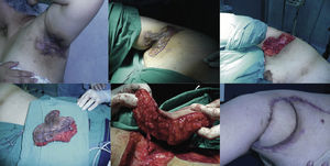 Arriba, a la izquierda: inflamación crónica y cicatrices con compromiso funcional de la axila izquierda. Arriba, al centro y derecha: marcación y resección hasta la fascia axilar superficial. Abajo, a la izquierda: escisión de espesor completo de la región axilar. Abajo, al centro: identificación del pedículo de la arteria circunfleja escapular y venas concomitantes. Abajo, a la derecha: cicatrices hipertróficas a los 6 meses postoperatorios.