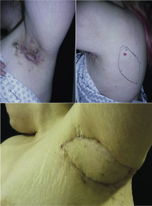Arriba, a la izquierda: axila izquierda con secuela de cicatrización y fístulas activas. Arriba, a la derecha: marcación preoperatoria del vaso perforante con Doppler sonido y diseño preliminar del colgajo. Abajo: evolución a los 6 meses postoperatorios.