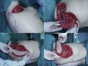 Arriba, a la izquierda: resección de la axila derecha, diseño del colgajo y marcación previa con Doppler de la perforante. Arriba, a la derecha: rotación del colgajo y el pedículo, sin tensión. Abajo: inset del colgajo.