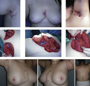 Control postoperatorio a los 18 meses de la reconstrucción axilar izquierda y 24 meses desde la reconstrucción axilar derecha y esternal. Arriba: lesiones en axila derecha, en región esternal (intermamaria) y en axila izquierda. Centro: resección y elevación del colgajo. Abajo: cicatrices axilares, esternales y de las zona dadora.