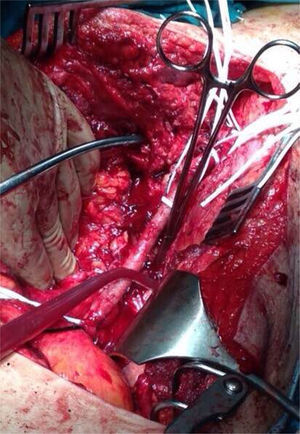 Imagen intraoperatoria tras la resección del tumor y exposición de la arteria iliaca derecha. Ligadura y sección de la vena iliaca trombosada.
