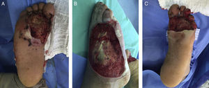 Imágenes luego de escarectomía. A. Cara plantar del pie derecho. B. Cara dorsal del pie derecho. C. Cara plantar del pie izquierdo.