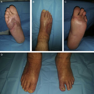 Control ambulatorio a las 3 semanas del alta. A. Cara plantar del pie derecho. B. Cara dorsal del pie derecho. C. Cara plantar del pie izquierdo. D. Paciente de pie.
