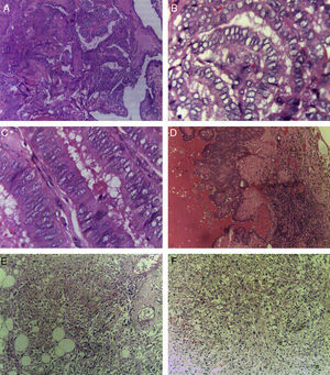 A)Carcinoma papilar de tiroides de variante clásica (H-E, ×10). B)Carcinoma papilar de tiroides, núcleos en vidrio esmerilado (H-E, ×40). C)Carcinoma papilar de tiroides de variante de células altas (H-E, ×40). D)Metástasis ganglionar de carcinoma papilar de tiroides de variante clásica (H-E, ×10). E, F)EAML; se observan elementos musculares, vasculares y adiposos (H-E, ×10).