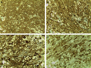 Marcadores inmunohistoquímicos positivos en EAML. A, B)Actina de músculo liso (×10 y ×40, respectivamente). C)HMB-45 (×40). D)Melan-A (×40).