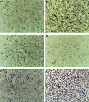 Marcadores inmunohistoquímicos negativos en EAML. A)ACE (×40). B)AE1-AE3 (×40). C)CD10 (×40). D)Ki67 (×40). E)RE117 (×40). F)TTF1 (×40).