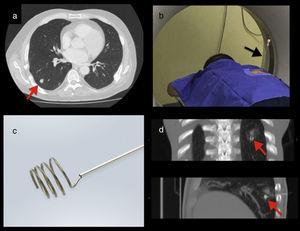 a) TC: nódulo pulmonar del lóbulo inferior derecho (flecha roja). b) TC: aguja de marcación in situ (flecha negra). c) Lung marker system (LMS). d) TC: LMS adyacente al nódulo (flechas rojas).