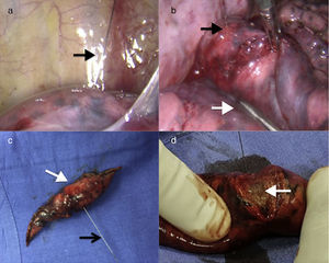 a) Imagen de videotoracoscopia con Lung marker system (LMS) señalando la ubicación del nódulo (flecha negra). b) Resección segmentaria (flecha blanca), incluyendo el LMS (flecha negra). c) Segmentectomía atípica (flecha blanca) incluyendo el LMS (flecha negra). d) Confirmación de la presencia del nódulo (flecha blanca).