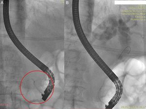 Colangiopancreatografía retrógrada endoscópica. A) Conducto pancreático principal (círculo rojo); B) Vía biliar dilatada.