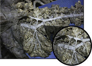 Vista anterior de sistema ductal pancreático. (1) Conducto pancreático accesorio (Santorini); (2) conducto pancreático principal (Wirsung). Flecha azul representando flujo de sistema ductal descompresivo.