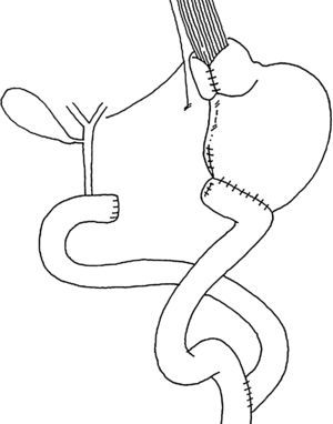 Fundoplicatura con cirugía de supresión ácida y derivación duodenal.