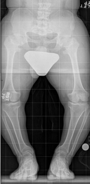 Telerradiografía de extremidades inferiores AP. Muestra la clásica imagen de un paciente acondroplásico: talla baja con un genu varo femoral y tibial.