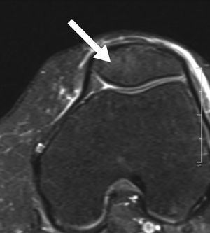 Resonancia magnética de rodilla donde se observa edema óseo de la rótula (flecha gruesa).