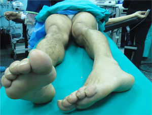 Caso 2. Se observa la deformidad clásica de la extremidad inferior izquierda acortada, en rotación interna y aducción.