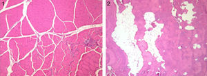 Muestra representativa de los cortes histológicos (100×) con tinción H-E de tejido de cuádriceps intervenido (2) vs control (1) del grupo sacrificado a las 12 semanas. Se observan grupos confluentes de tejido adiposo que disecan las fibras musculares.