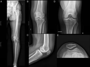 Estudio radiológico de la OA de rodilla. A. Telerradiografía de la extremidad afectada. B. Proyección AP demostrando una OA de predominio en el compartimento medial, lo cual se logra apreciar de mejor forma en la proyección de Rosenberg (D). Tanto en la proyección lateral (C) como en la axial de rótula (D) se aprecian cambios precoces. (E) Proyección axial de rótula donde se aprecian osteofitos mediales y esclerosis subcondral.