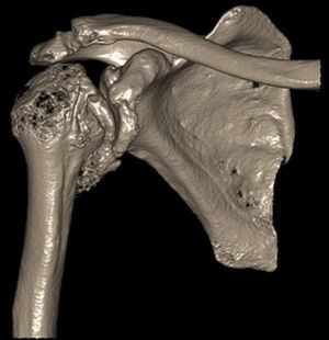 TC del hombro derecho. Se aprecia colapso articular de la cabeza humeral, incongruencia articular, importantes cambios degenerativos, artrosis de fosa glenoidea y gran osteofito inferior, que determinan el bloqueo mecánico descrito.