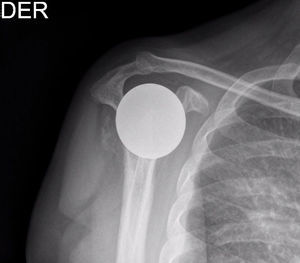 Radiografía del hombro derecho, proyección outlet, control postoperatorio a los 18 meses de seguimiento. Se aprecia implante in situ.